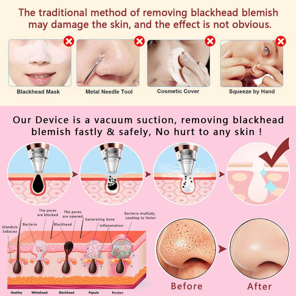 Powerful Blackhead Acne Remover Vacuum Cleaner Black Head Face Skin Care Extractor Pore Nose Lift Suction Facial Removal Massage